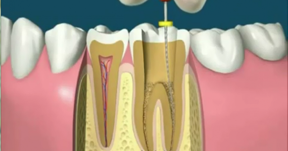 ENDODONTIA-tratamento de canal